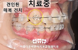 수술후