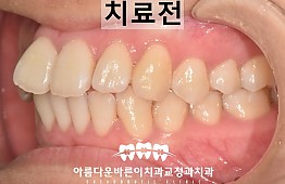 수술전