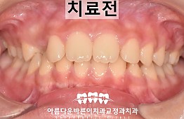 수술전