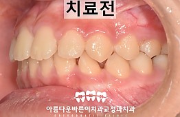 수술전