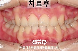 수술후