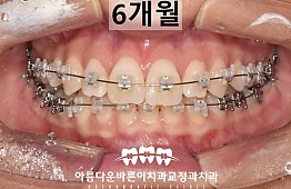 수술후