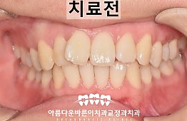 수술전