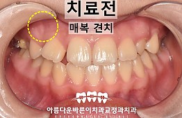 수술전