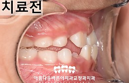 수술전