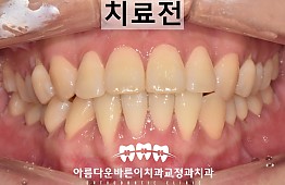 수술전