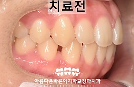 수술전