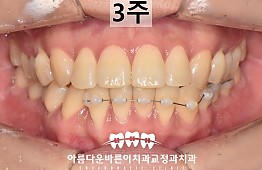 수술후