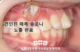 수술후