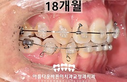 수술후