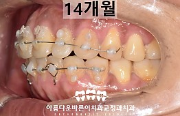수술후