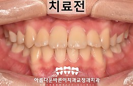 수술전