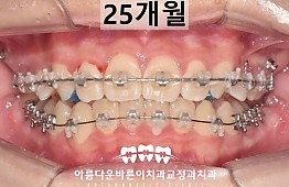 수술후