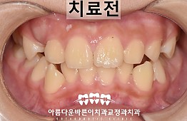 수술전