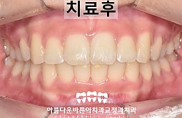 수술후