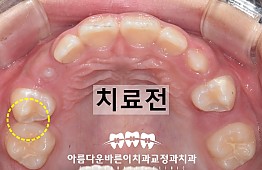 수술전