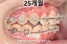 수술후