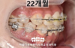 수술후