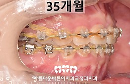 수술후