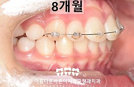 수술후