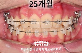 수술후