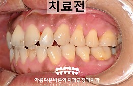 수술전