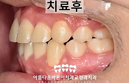 수술후