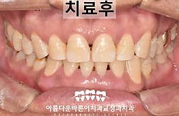 수술후