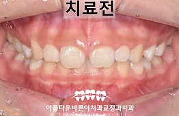 수술전