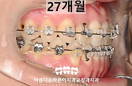 수술후