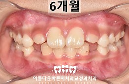 수술후