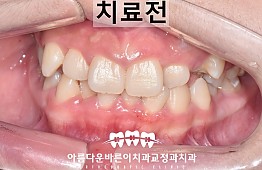 수술전