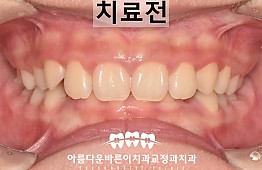 수술전