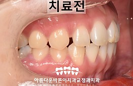 수술전