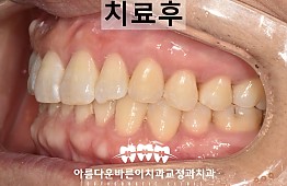 수술후