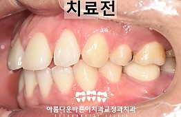 수술전