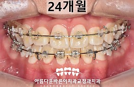 수술후