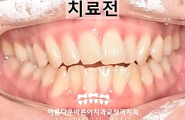 수술전