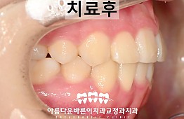 수술후