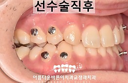 수술후