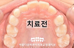 수술전