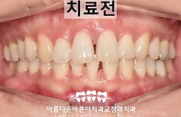 수술전