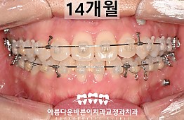 수술후
