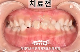 수술전