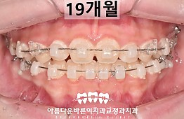 수술후