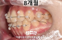 수술후