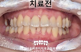 수술전