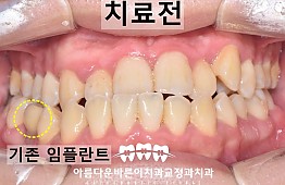 수술전