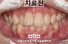 수술전