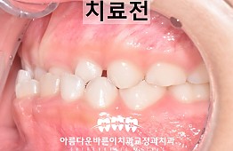 수술전